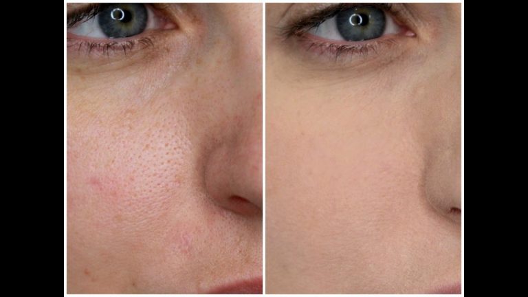 Pores dilatés – Photoderma